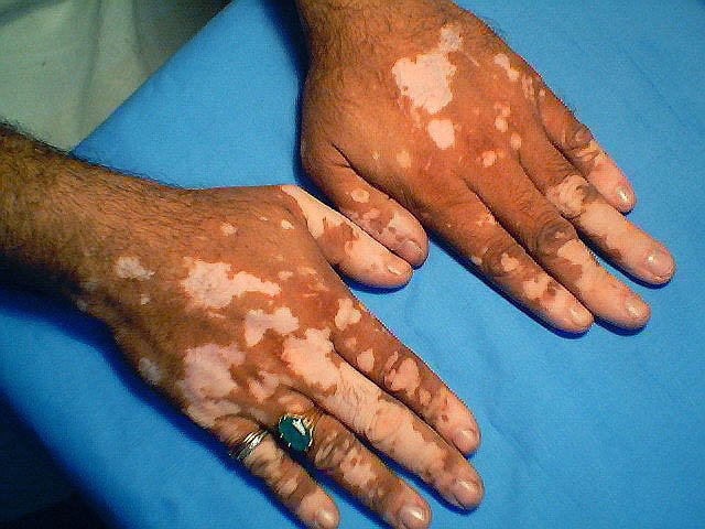 Vitiligo on fingers