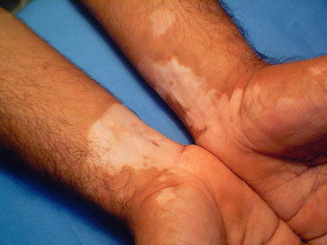 Vitiligo on hands