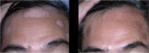 EXCIMER LASER FOR VITILIGO